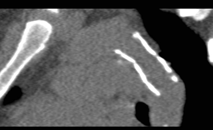 Repair of Coarctation of the Aorta with Stent in Place - CTisus CT Scan