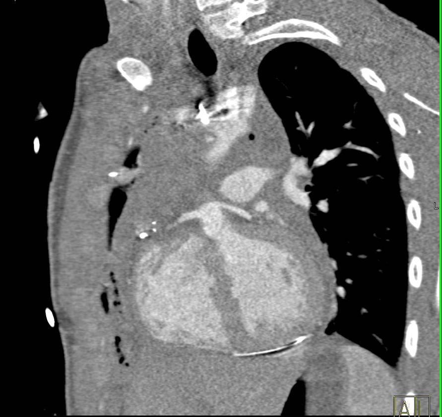 Left Main Coronary Artery and Right Coronary Artery Arise from the Right Cusp - CTisus CT Scan