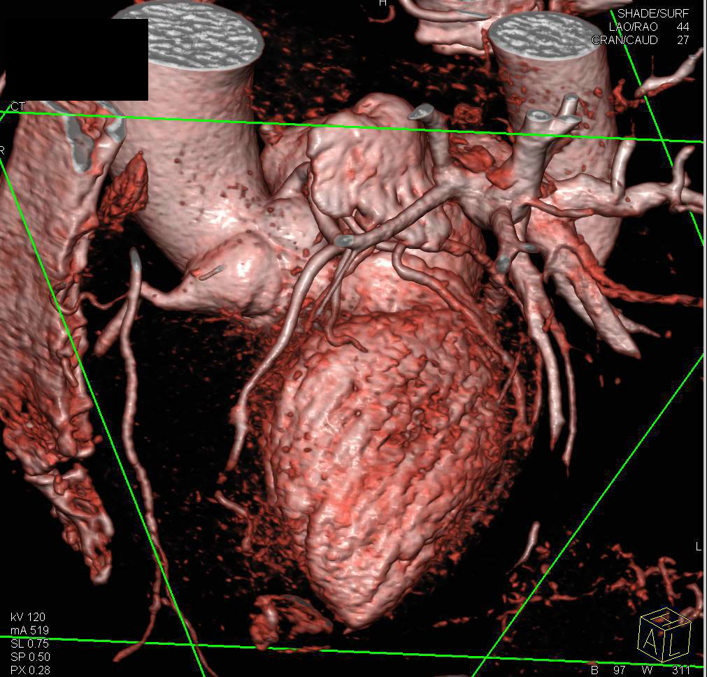 3D Mapping of the Coronary Arteries - CTisus CT Scan