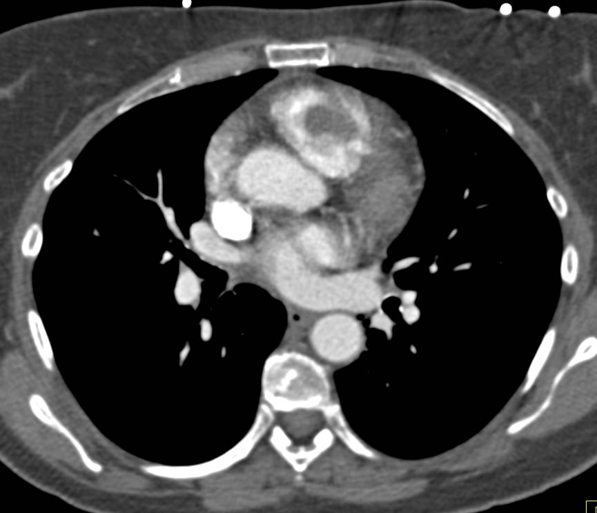 Tumor in Right Ventricle from Cervical Carcinoma (rare) - CTisus CT Scan