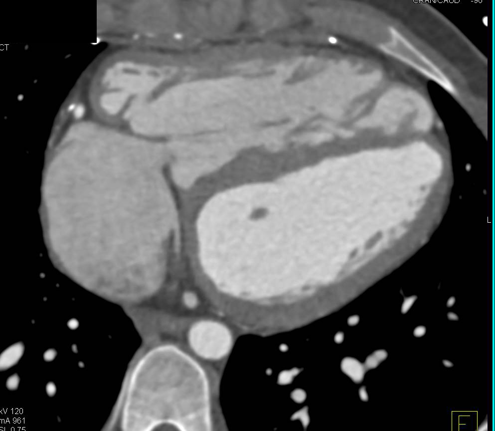 Tetralogy of Fallot Repair with Pulmonary Artery Stents - CTisus CT Scan