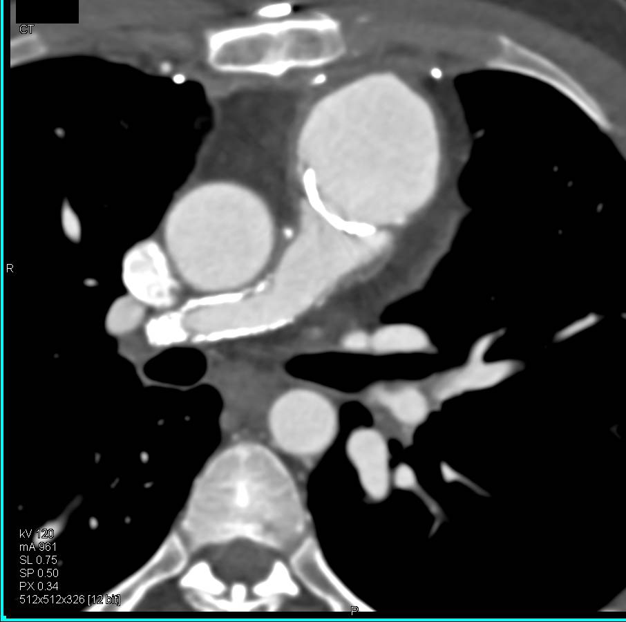 Patent Stents in Pulmonary Arteries in Patient with a History of Tetralogy of Fallot - CTisus CT Scan