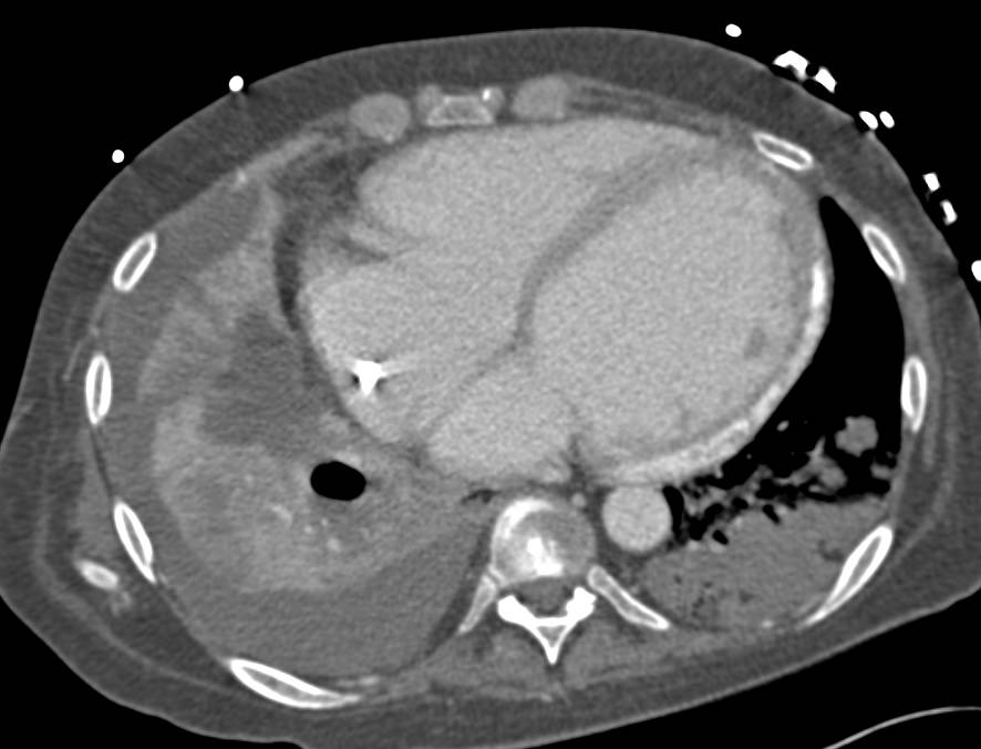 Pericardial Calcification with Poor Cardiac Function and Prior Liver Infarcts - CTisus CT Scan