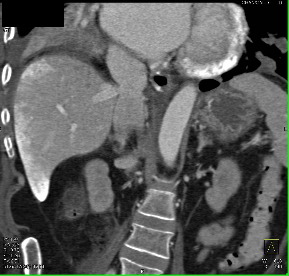 Calcified Pericardium and Prior Liver Infarction in Liver Transplant patient - CTisus CT Scan