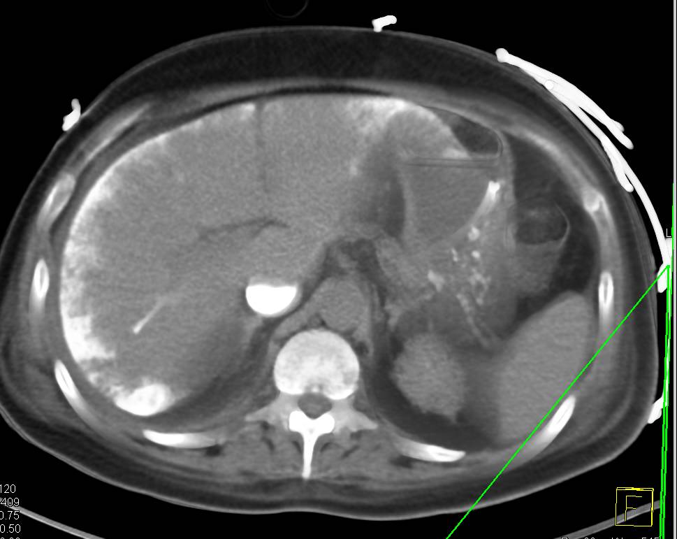 Amazing Case with Pericardial Calcification and Calcification Edge of Liver in Patient with ESRD (end stage renal disease) - CTisus CT Scan