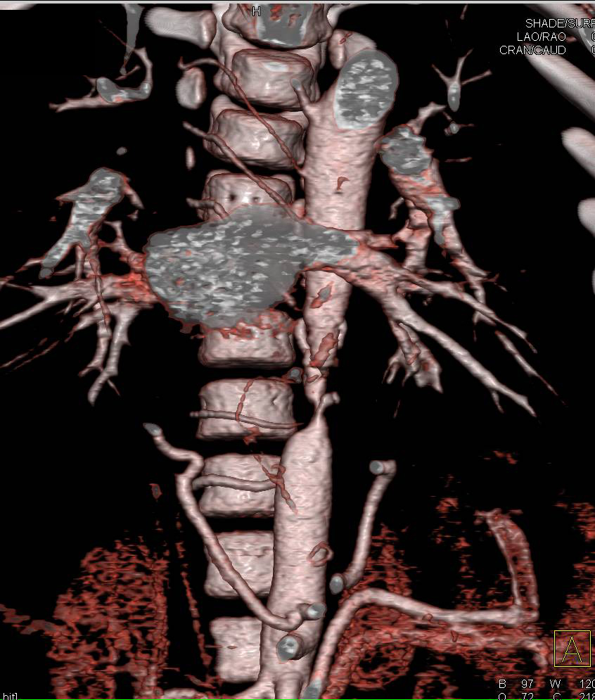 Unusual Case of Interrupted Descending Thoracic Aorta with Intercostal Collaterals - CTisus CT Scan
