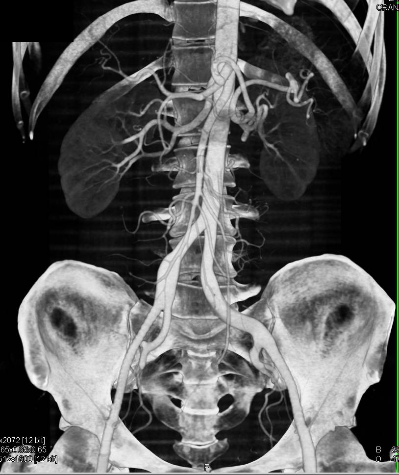 Takayasu's Arteritis with Left Subclavian Stenosis and Dissection and Stenosis of Left Vertebral. Iliac Artery Aneurysm Also Noted. - CTisus CT Scan