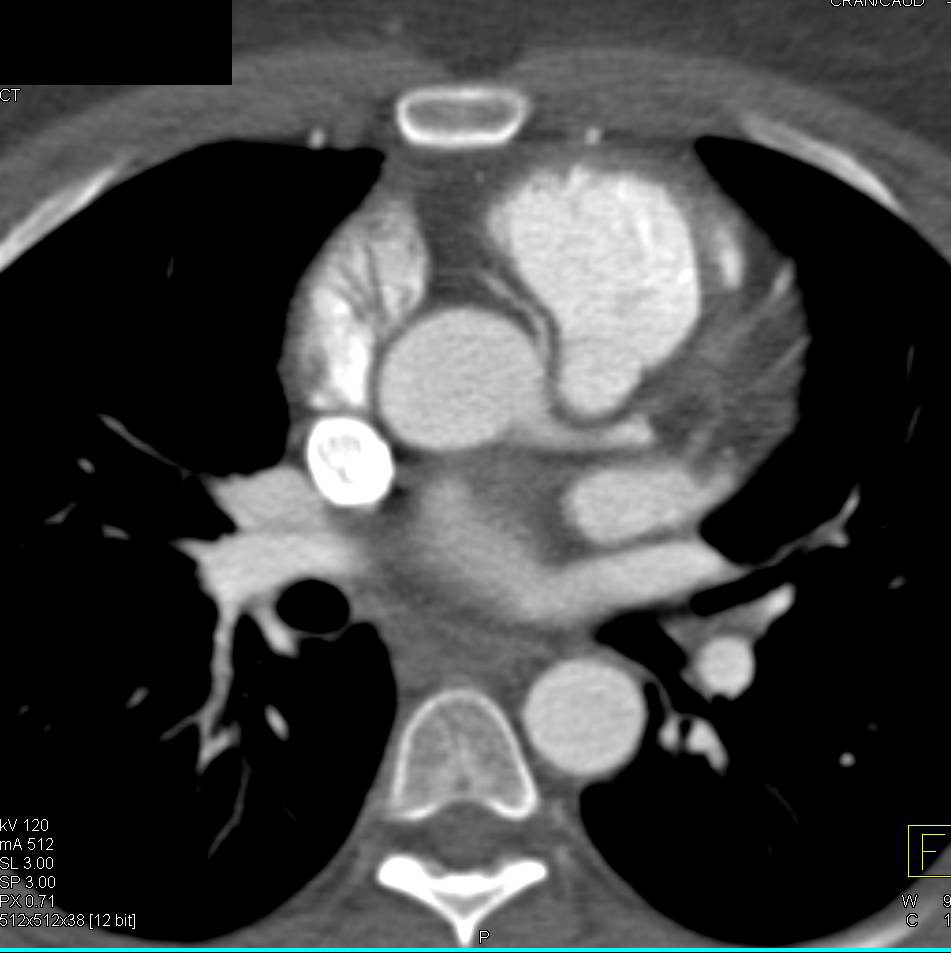 CCTA: Anomalous Origin of the Right Coronary Artery off the Left Cusp - CTisus CT Scan