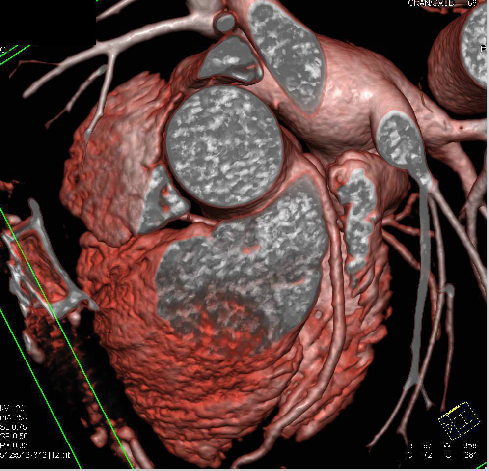 CCTA: Right Coronary Artery Arises off the Left Cusp - CTisus CT Scan