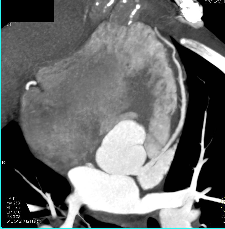 CCTA: Normal Left Main and Left Anterior Descending Coronary Artery (LAD) - CTisus CT Scan