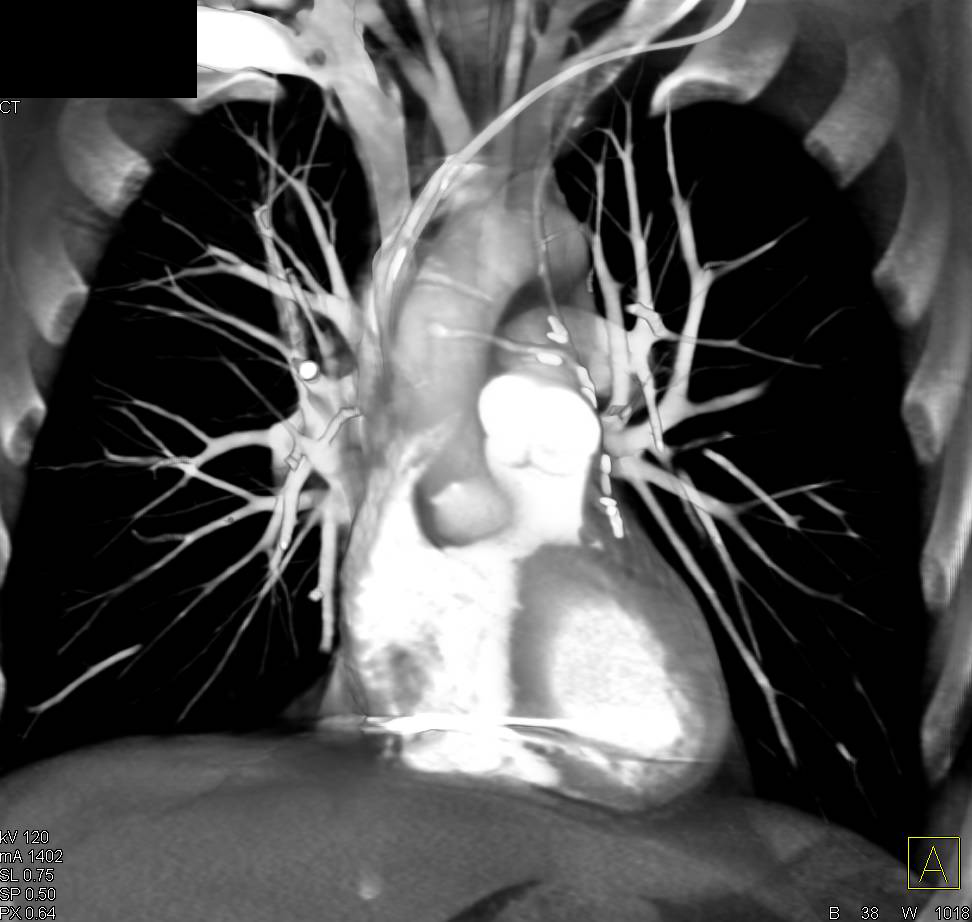 Coronary Artery Bypass Graft (CABG) with Venous and Left Internal Mammary Artery (LIMA) Grafts - CTisus CT Scan