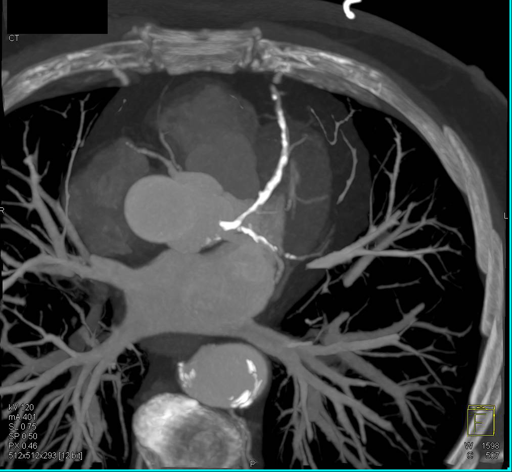CCTA with Extensive Calcified Plaque in the Left Anterior Descending Coronary Artery (LAD) - CTisus CT Scan