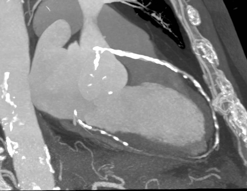 CCTA: Extensive Calcified Left Anterior Descending Coronary Artery (LAD) Plaque - CTisus CT Scan