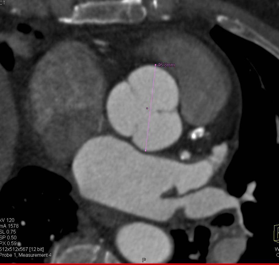 Dilated Aortic Root - CTisus CT Scan