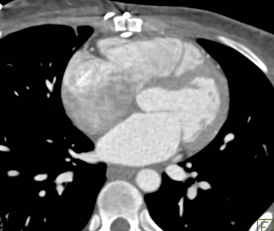 CCTA Shows the Right Coronary Artery Arising off the Left Cusp in a Malignant Configuration - CTisus CT Scan