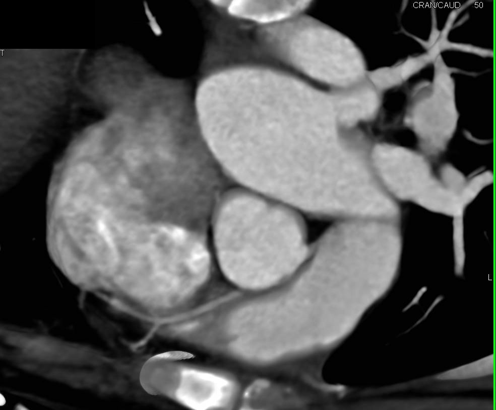 Right Coronary Artery Arises off the Left Cusp inn a Malignant Configuration - CTisus CT Scan