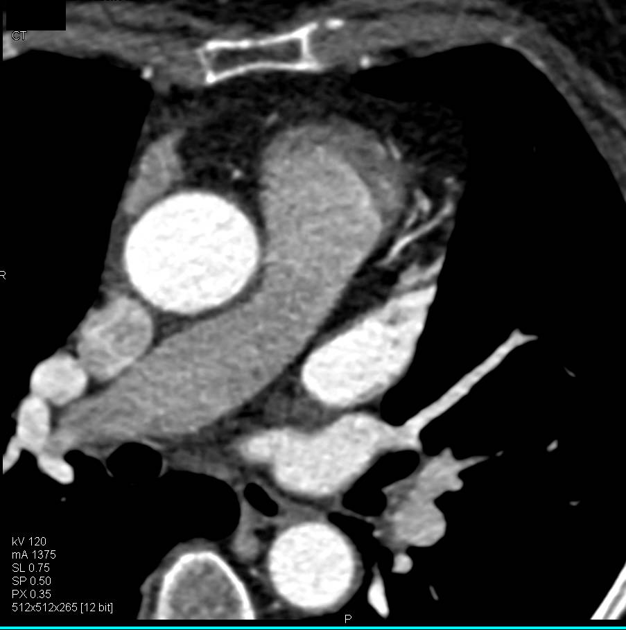 CCTA: Circumflex Coronary Artery Arises off Right Cusp in a Nonmalignant Configuration - CTisus CT Scan