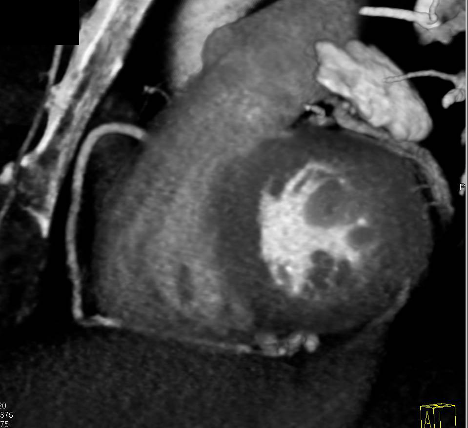 CCTA: Right Dominant Circulation - CTisus CT Scan