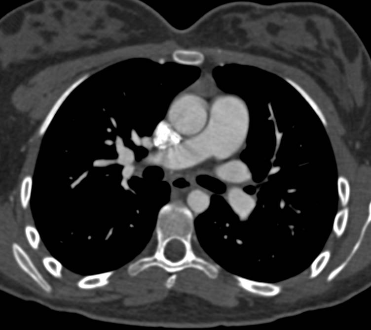 Coarctation of the Aorta Repaired with a Stent Across the Narrowing (COA) - CTisus CT Scan