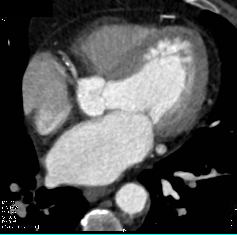 CCTA: Mixed Plaque in the Right Coronary Artery - CTisus CT Scan