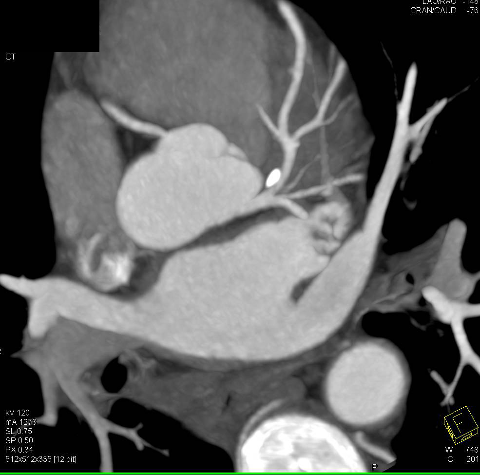 CCTA: Left Anterior Descending Artery (LAD) Plaque Without Critical Stenosis - CTisus CT Scan