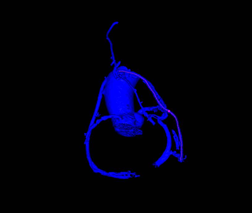 Patent Bypass Graft - CTisus CT Scan