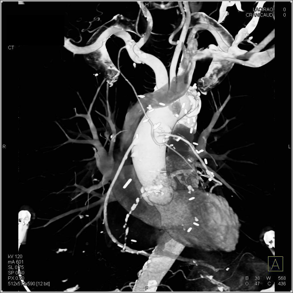 3D Map of Venous Grafts and Right Internal Mammary Artery (RIMA) Graft with Failed Left Internal Mammary Artery (LIMA) Graft - CTisus CT Scan