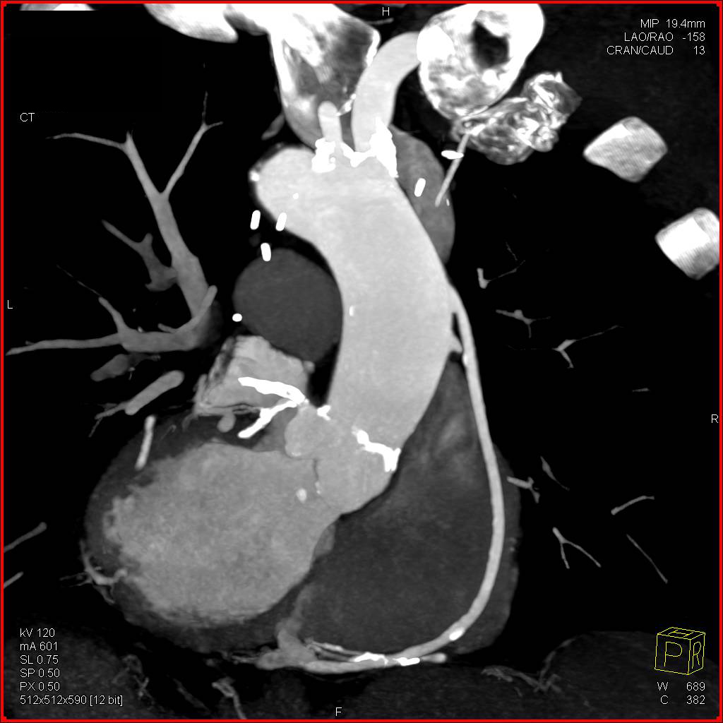 3D Mapping of Coronary Artery Bypass Grafts - CTisus CT Scan