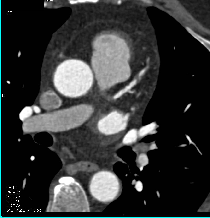 CCTA with Left Anterior Descending Coronary Artery (LAD) Occlusion - CTisus CT Scan