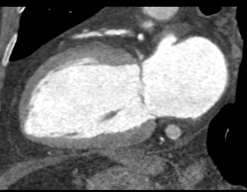 CCTA: Greater than 70% Stenosis in the Left Anterior Descending Coronary Artery (LAD) - CTisus CT Scan