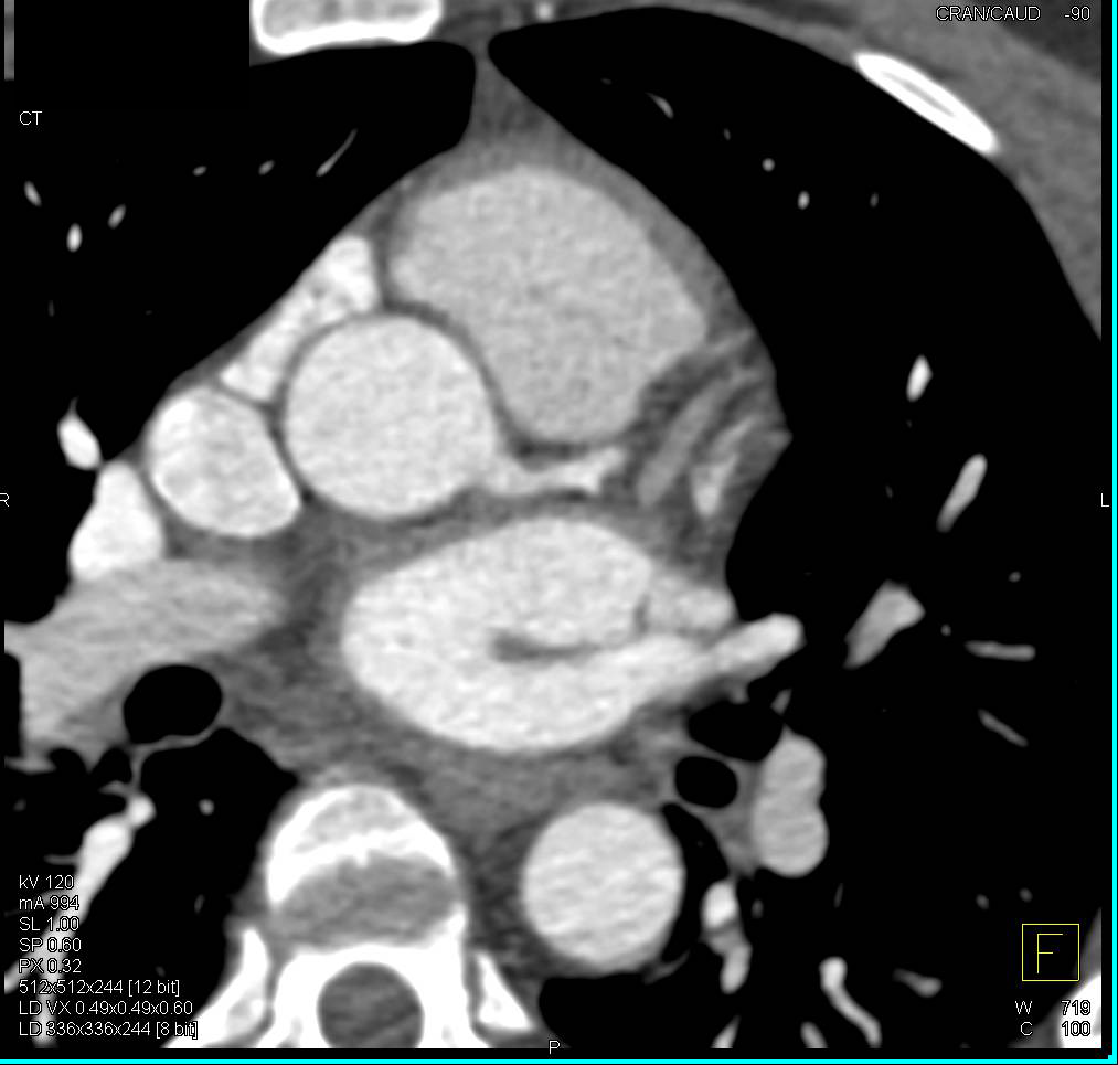 CCTA: Non-Calcified Plaque in Left Main Coronary Artery - CTisus CT Scan