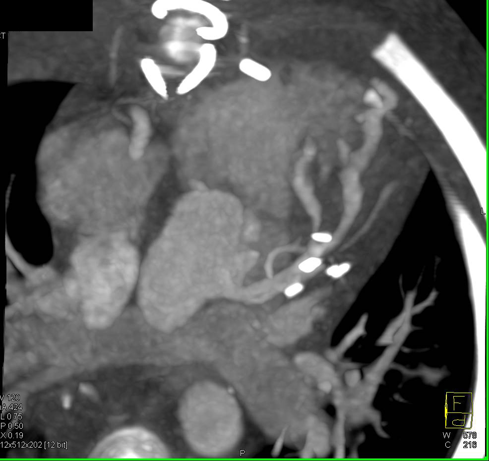 Reimplanted LAD - CTisus CT Scan