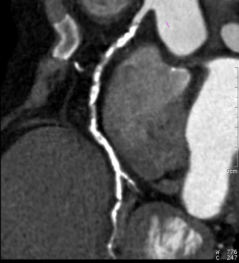 CCTA: Multivessel Disease with Calcified and Non-calcified Plaque and Agatston Score of 2152 - CTisus CT Scan