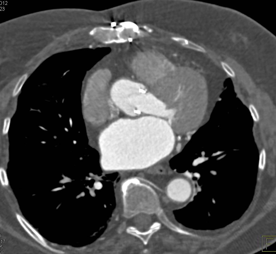 CCTA: Coronary Artery Bypass Graft (CABG) and Aortic Valve Replacement (AVR) - CTisus CT Scan