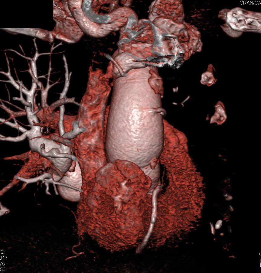 Coronary Artery Bypass in 3D - CTisus CT Scan