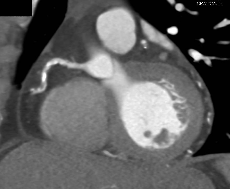 CCTA: Multivessel Disease with Calcified and Non-calcified Plaque - CTisus CT Scan