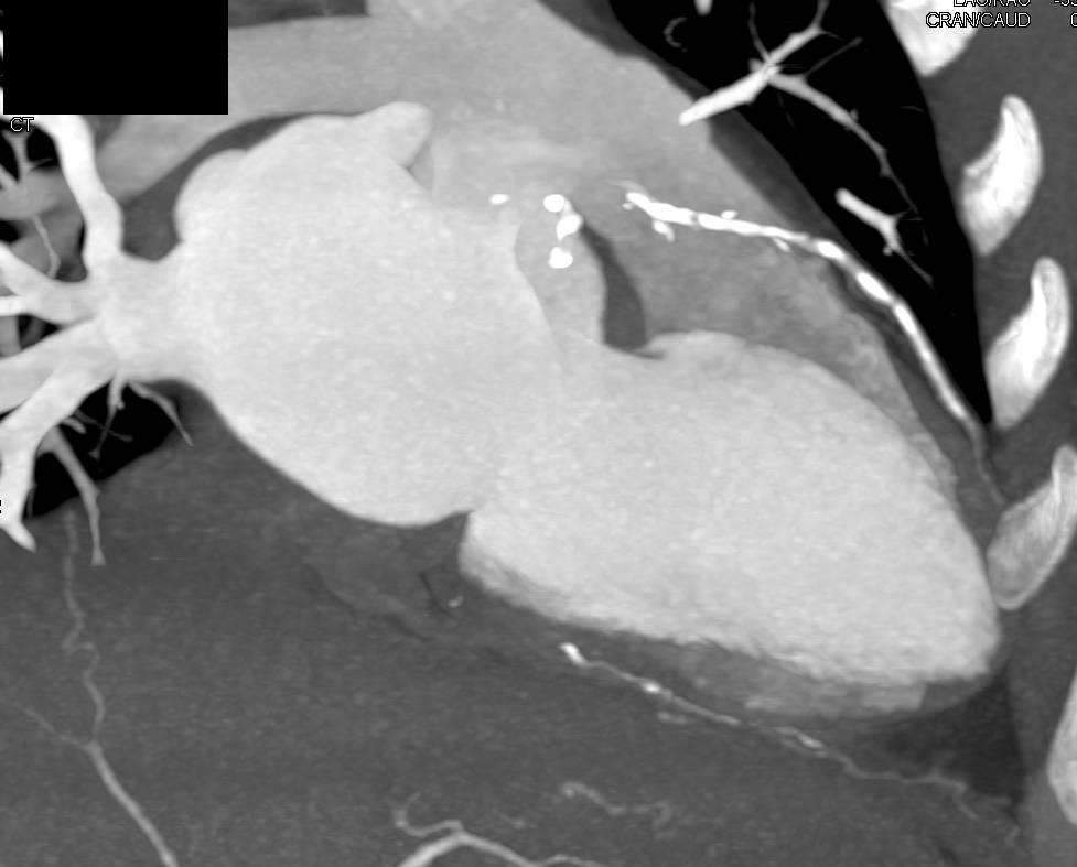 CCTA: Mixed Plaque in the Left Anterior Descending Coronary Artery (LAD) - CTisus CT Scan