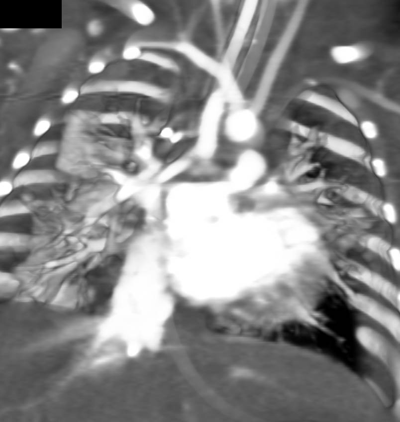 Tetralogy of Fallot with Graft From Right Subclavian Artery to Pulmonary Artery - CTisus CT Scan