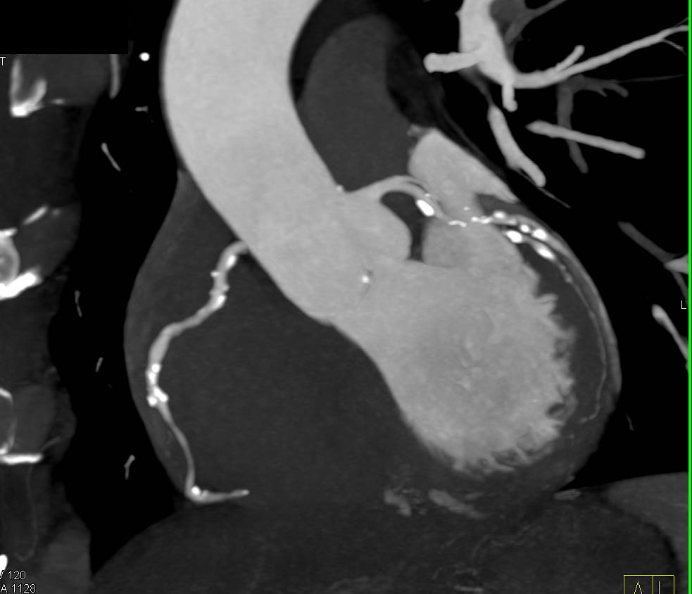 CCTA: MIP Shows Extensive Coronary Artery Disease - CTisus CT Scan