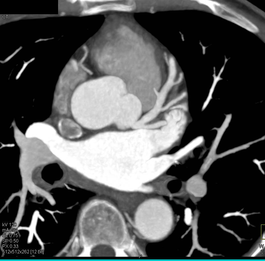 CCTA:Right Dominant Circulation - CTisus CT Scan