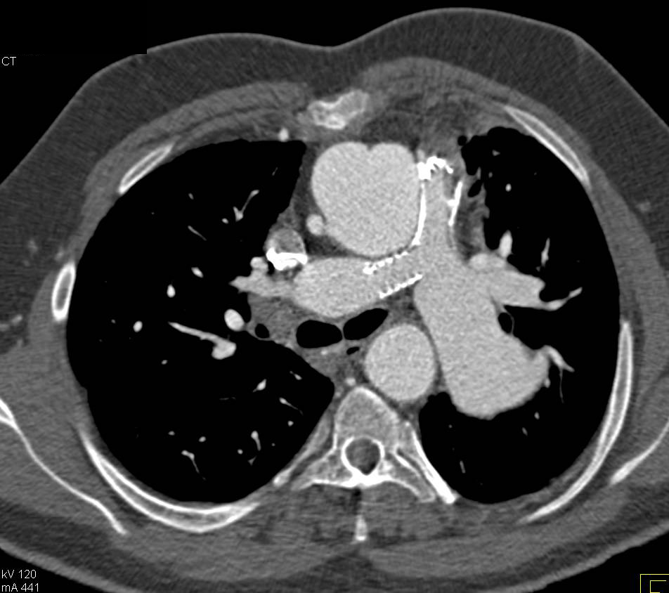 Congenital Heart Disease with Stent in the Right Pulmonary Artery - CTisus CT Scan