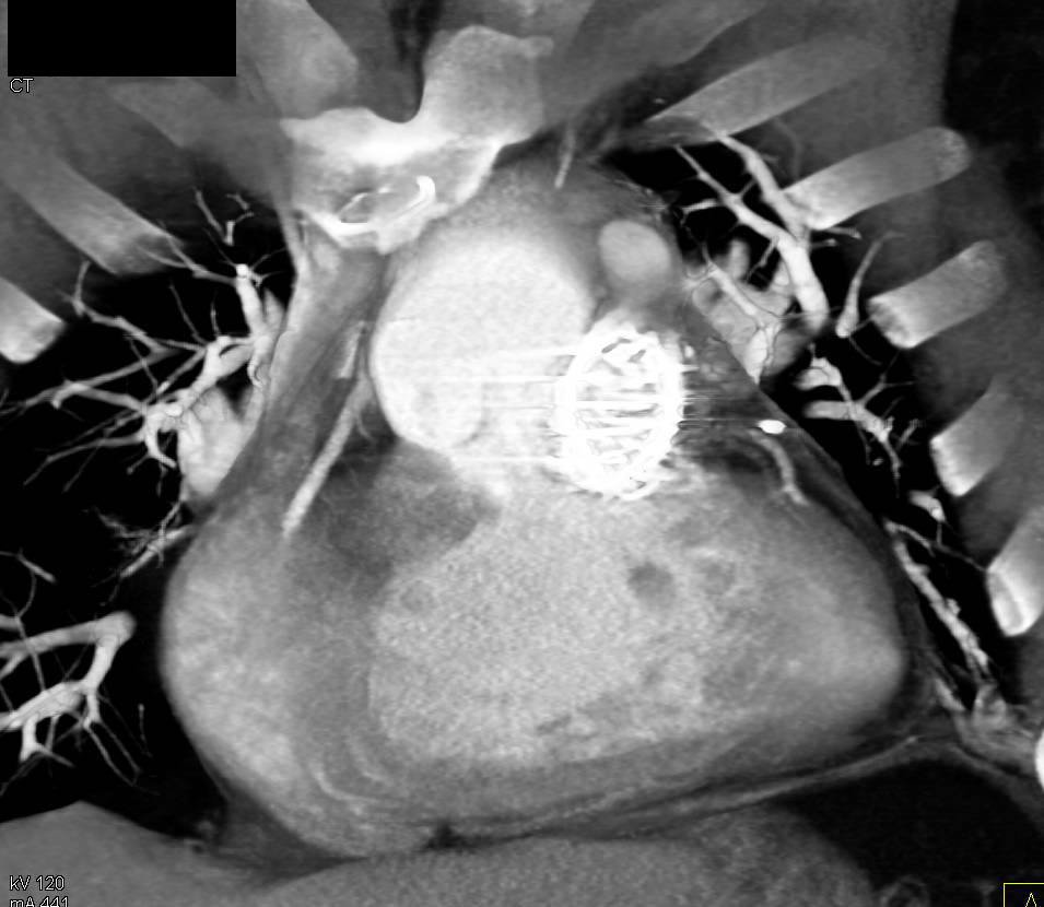 Tetralogy of Fallot with Pulmonary Artery Stent - CTisus CT Scan