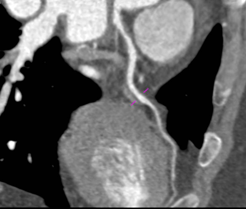 CCTA: Left Anterior Descending Artery (LAD) Noncalcified Plaque on Curved Planar Reconstruction - CTisus CT Scan