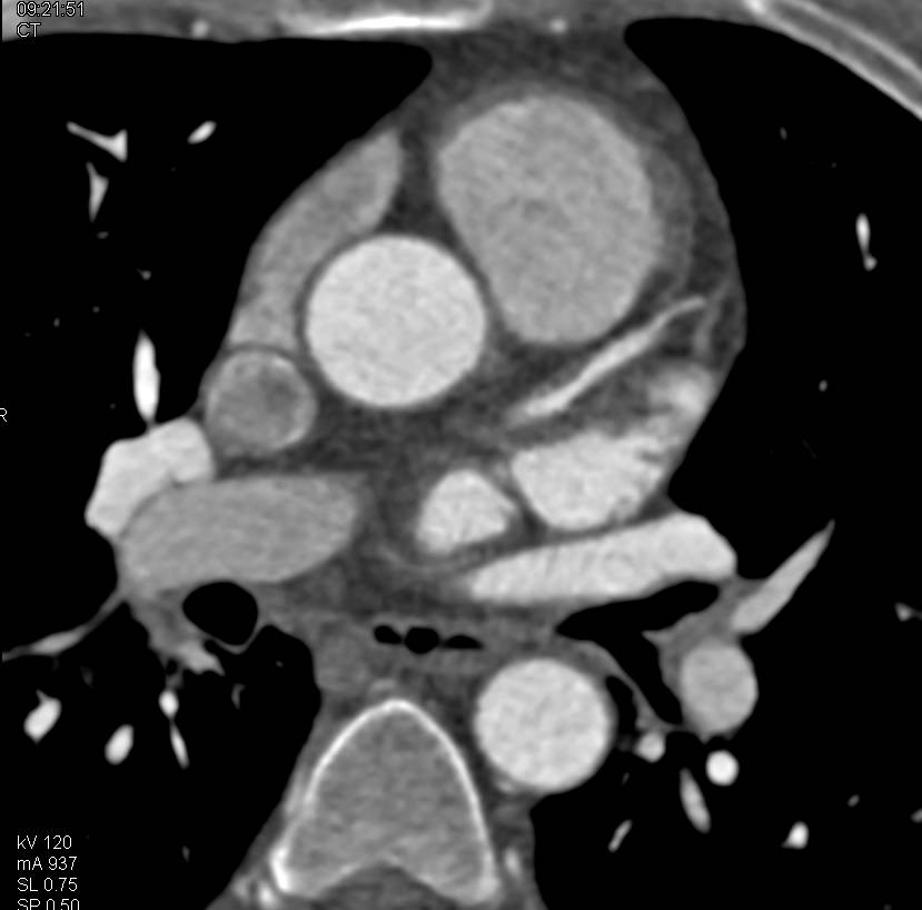 CCTA with Left Anterior Descending Coronary Artery (LAD) Stenosis over 50% by Noncalcified Plaque - CTisus CT Scan