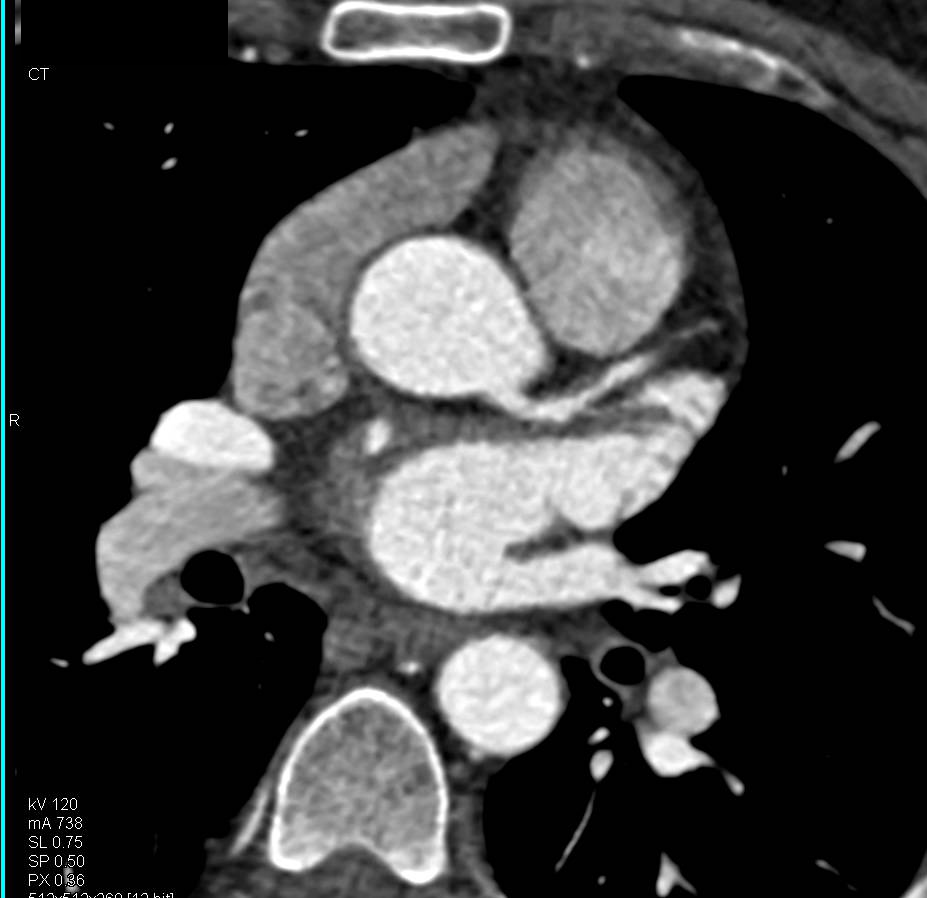 CCTA: Mixed Plaque in Left Anterior Descending Coronary Artery (LAD) with Approximately 50% Stenosis - CTisus CT Scan