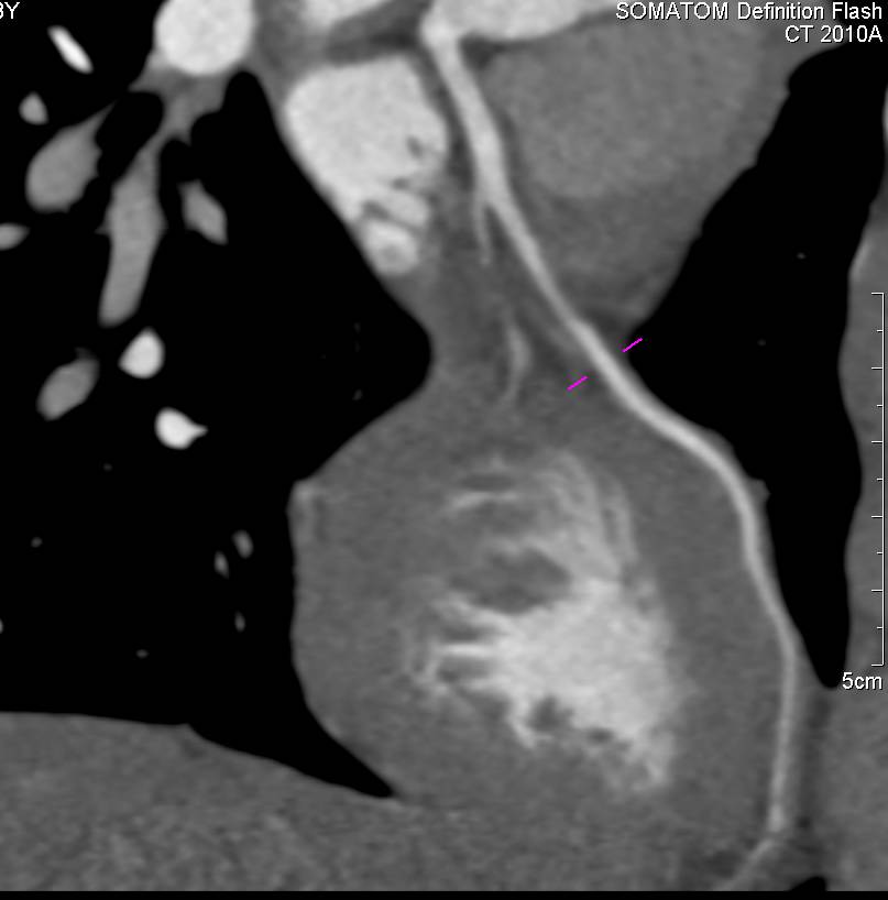 CCTA: Left Anterior Descending Coronary Artery (LAD) Stenosis - CTisus CT Scan