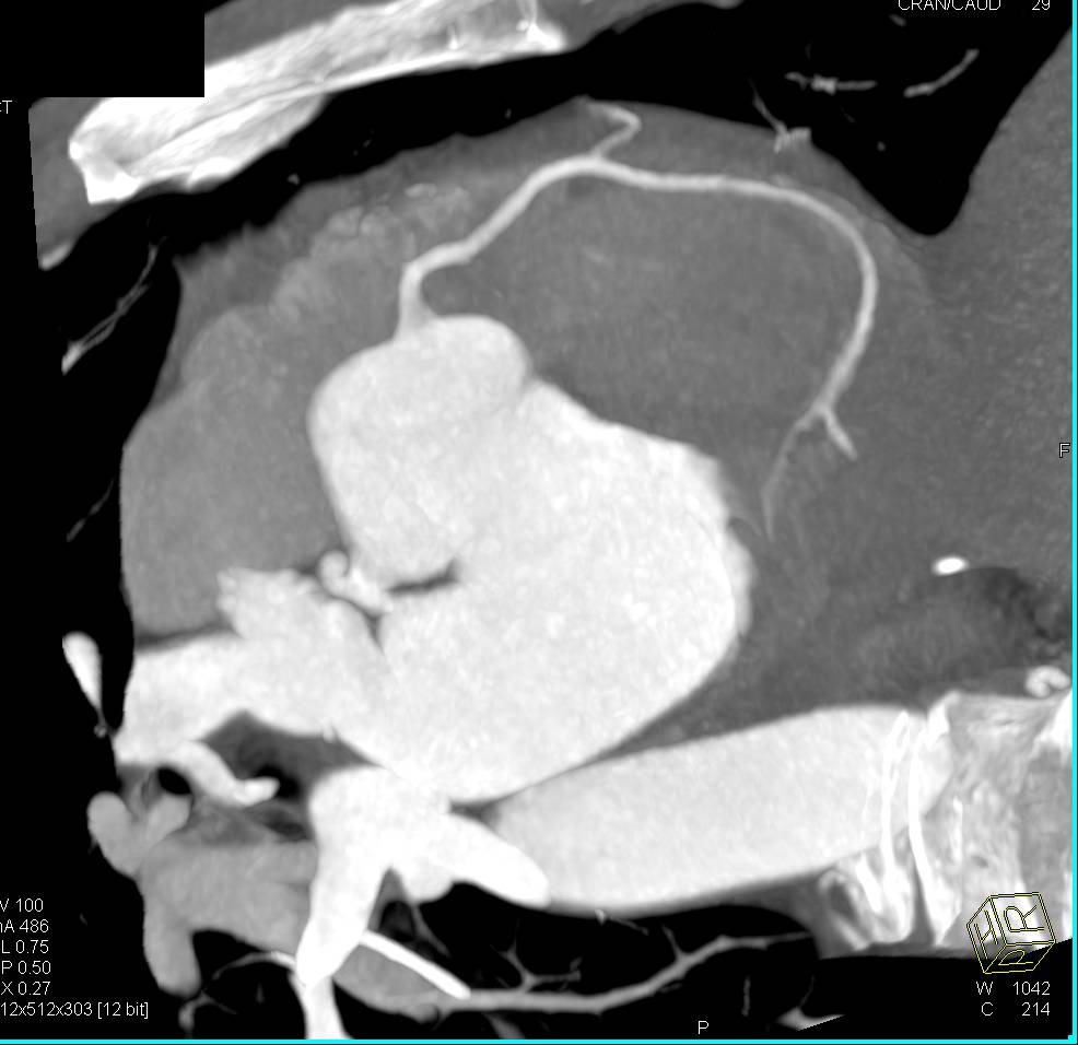 CCTA: Normal Coronary Arteries - CTisus CT Scan