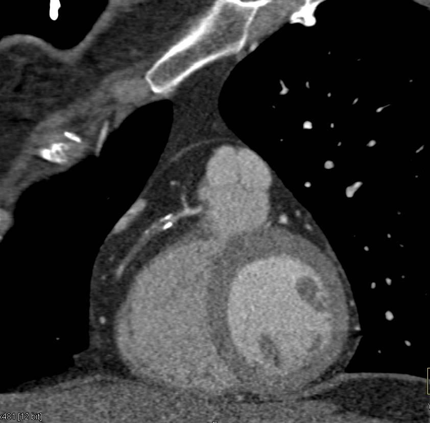 CCTA: Occluded Right Coronary Artery - CTisus CT Scan