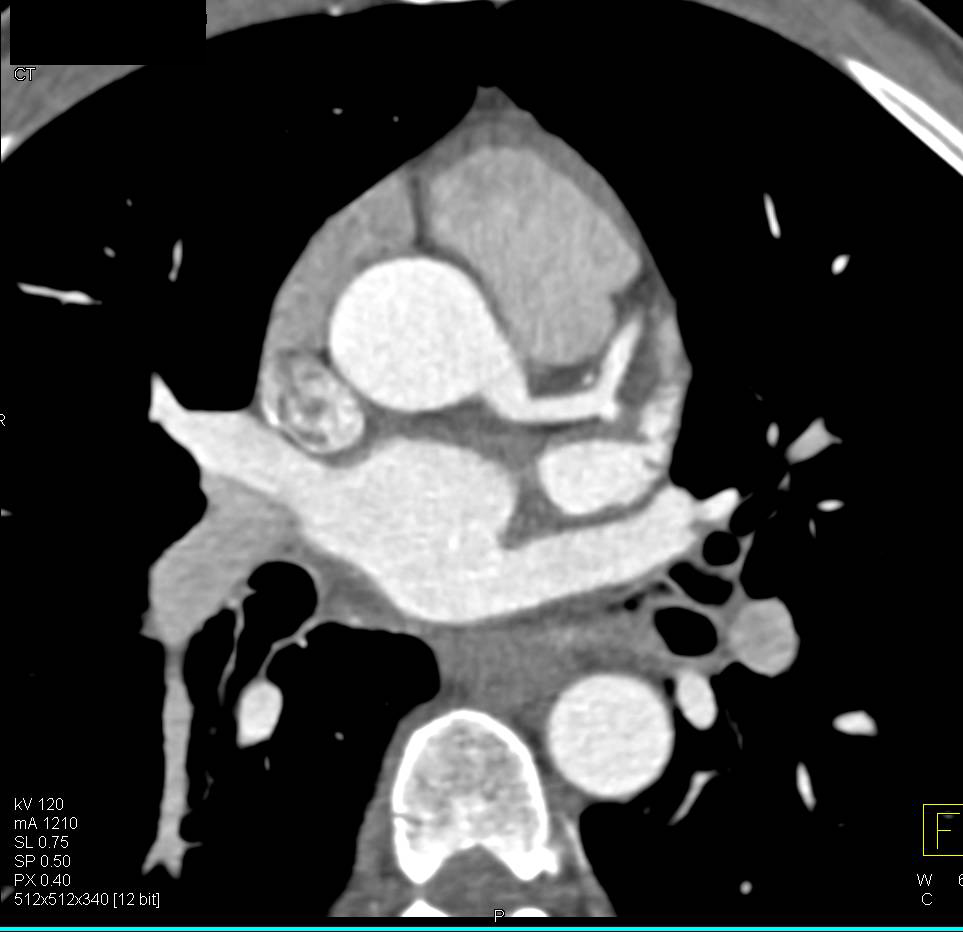 CCTA: Minimal Calcified and Noncalcified Left Anterior Descending Coronary Artery (LAD) Plaque - CTisus CT Scan