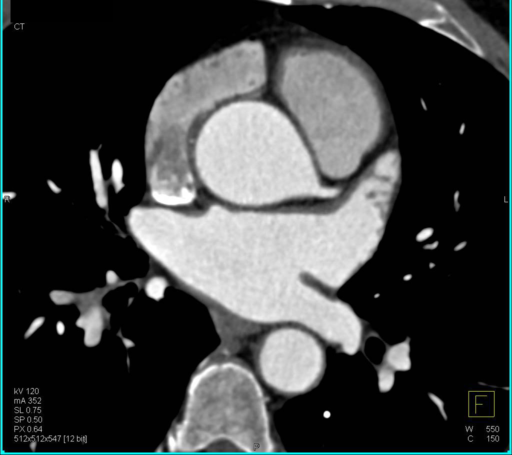 Dilated Aortic Root with Center Line Measurement - CTisus CT Scan